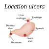 Natural Ways to Heal Ulcers